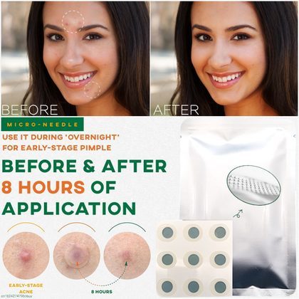 9 Patches Microneedle Acne Pimple Healing Patch Anti Acne Pimple Patch Soothing Face Skin Healing Zit Stickers Blemish Treatment